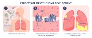 mesothelioma and asbestos lawyers